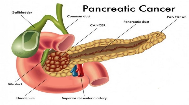 Pancreatic Cancer Treatment in Mumbai